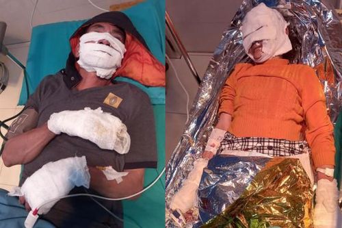 Điện thoại phát nổ, hai vợ chồng bị bỏng nặng