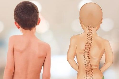 Vẹo cột sống khởi phát sớm ở trẻ nhỏ: Nguyên nhân và dấu hiệu nhận biết