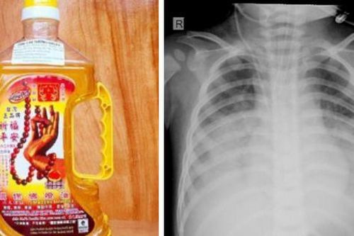 Uống nhầm dầu thắp đèn, bé 15 tháng tuổi nguy kịch
