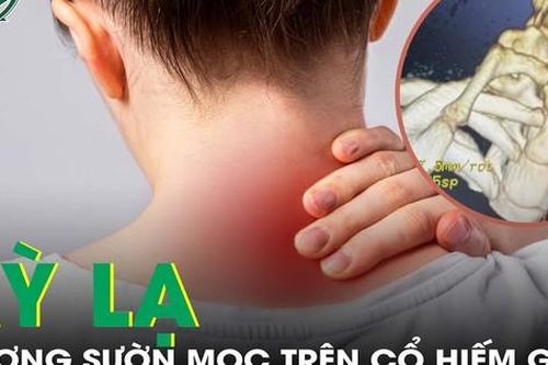 Kỳ lạ xương sườn mọc trên... cổ hiếm gặp