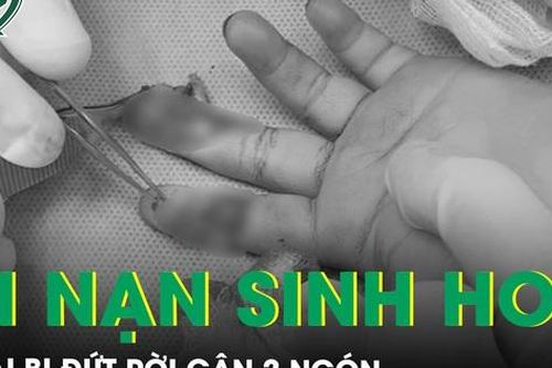 Nối gân ngón tay đứt rời cho bé gái bị tai nạn sinh hoạt