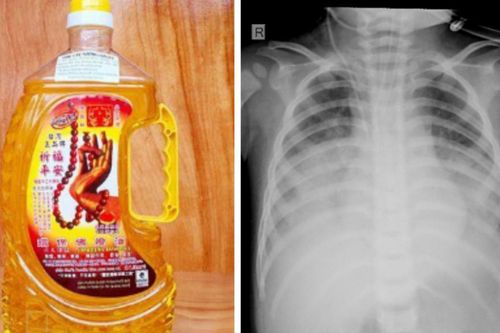 Bé 15 tháng tuổi nguy kịch nhập viện khẩn vì uống nhầm thứ thường thấy ở nhiều gia đình