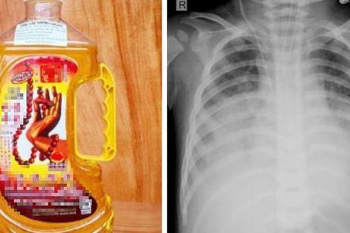 Uống dầu thắp đèn, một trẻ tím tái phải thở máy