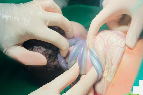 Bé trai chào đời với 4 vòng dây rốn quấn cổ