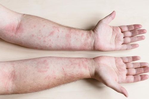 Viêm mô tế bào là gì? Những điều cần biết về tình trạng này