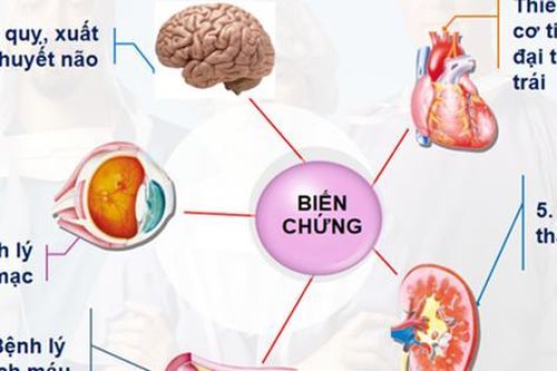 Duy trì hoạt động thể chất giúp giảm huyết áp cao