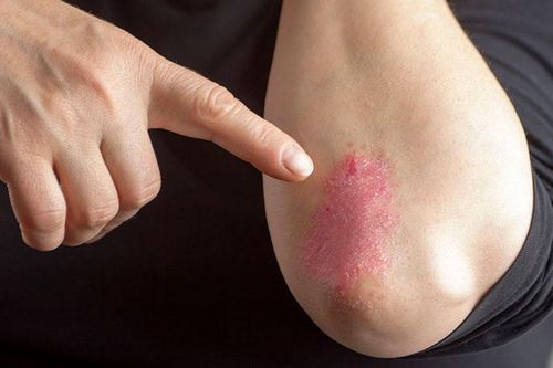 Liệu pháp giảm đau, viêm cho người bệnh viêm khớp vẩy nến