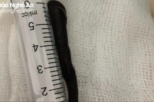 Gắp con đỉa dài hơn 6 cm ra khỏi khí quản bệnh nhân