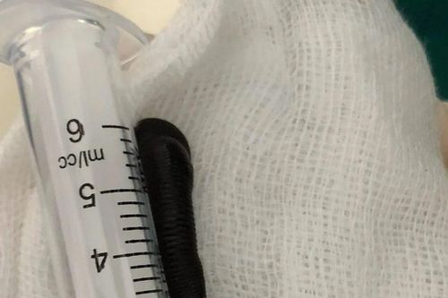 Phát hiện con đỉa còn sống trong khí quản của bệnh nhân
