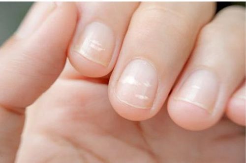 Những dấu hiệu trên móng tay báo hiệu điều gì?