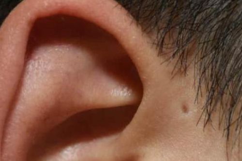 Mối nguy từ lỗ nhỏ hay bị bỏ qua ở vành tai