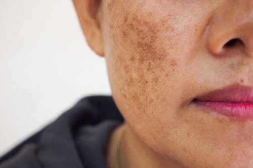 Bác sĩ trả lời: Bị nám da, điều trị bằng cách hiệu quả nào?