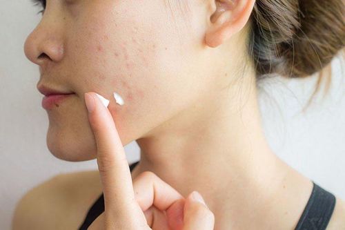 Cách sử dụng 3 hoạt chất thường dùng bôi trị mụn trứng cá