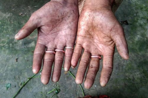 Nỗi khổ của những người không có dấu vân tay