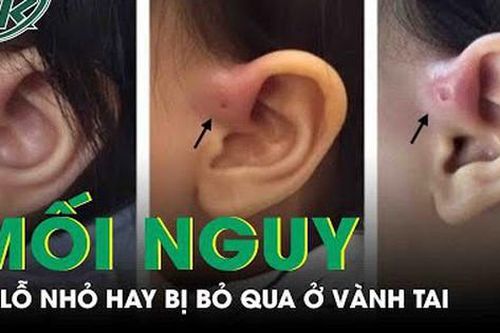 Mối nguy từ lỗ nhỏ hay bị bỏ qua ở vành tai