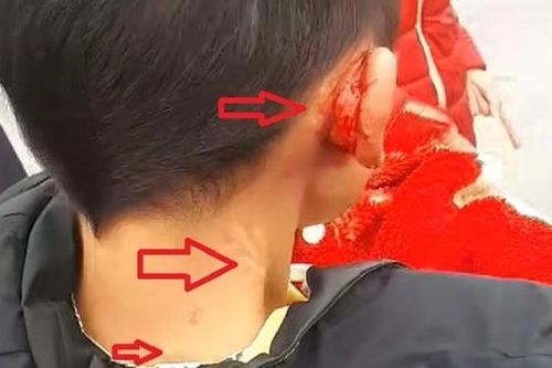 Bé trai bế em nghi bị mẹ đẻ bạo hành, đánh chảy máu tai giữa đường gây phẫn nộ