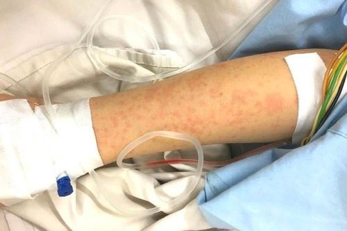 Cấp cứu thành công người phụ nữ bị sốc phản vệ sau tiêm vaccine