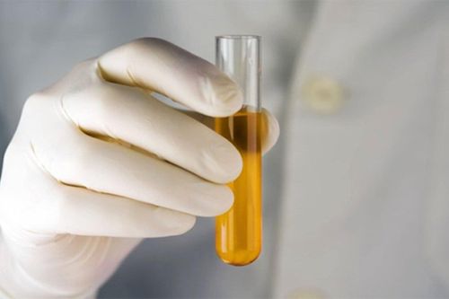 Đi khám ngay nếu thấy nước tiểu có màu này vào sáng sớm