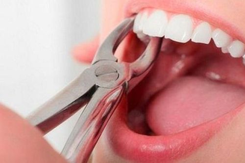 Những nhận định sai lầm khi nhổ răng