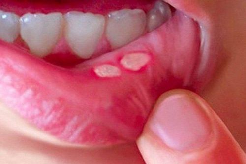 Làm gì khi trẻ bị viêm loét miệng?