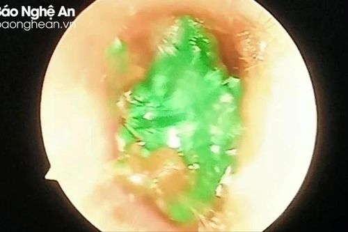 Gắp thành công dị vật là đất sét trong tai trẻ nhỏ