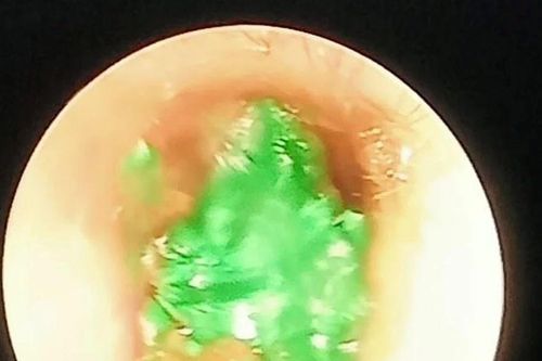 Gây mê lấy dị vật trong tai bệnh nhi 46 tháng tuổi ở Nghĩa Đàn