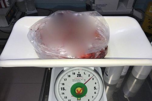 Đồng Nai: Cắt bỏ khối u nặng 2,5kg trong ngực người đàn ông