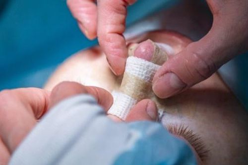 Biến dạng, nhiễm trùng vì đi sửa mũi theo quảng cáo