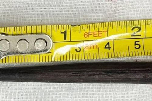 Thanh niên ở Bình Dương không hay biết có đũa gỗ dài 6cm trong mắt