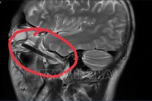 Người đàn ông bị đầu đũa dài 6 cm đâm sâu vào hốc mắt