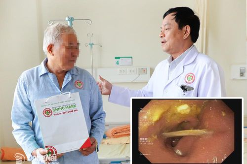 Nội soi gắp xương cá dài 4cm ra khỏi dạ dày bệnh nhân