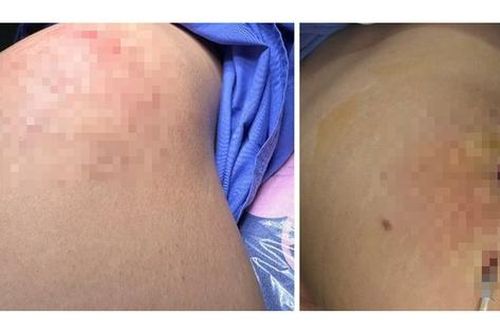 Người phụ nữ 31 tuổi bị áp xe mông sau tiêm filler làm đẹp ở spa