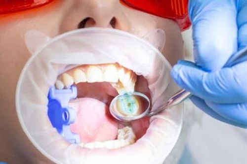 6 biểu hiện của sâu răng cần lưu ý