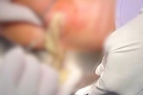 Vòng 3 biến thành ổ mủ sau 4 năm tiêm filler tăng kích thước