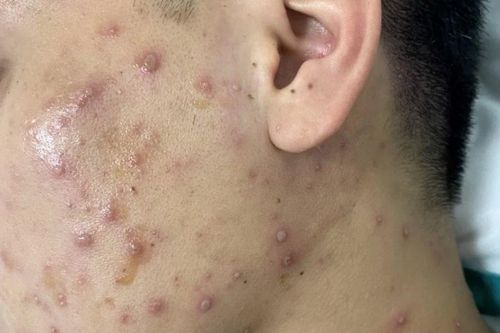 Làm gì để tránh những biến chứng nguy hiểm của bệnh thủy đậu?