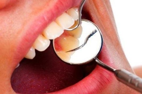 Viêm nướu răng làm sao hết?