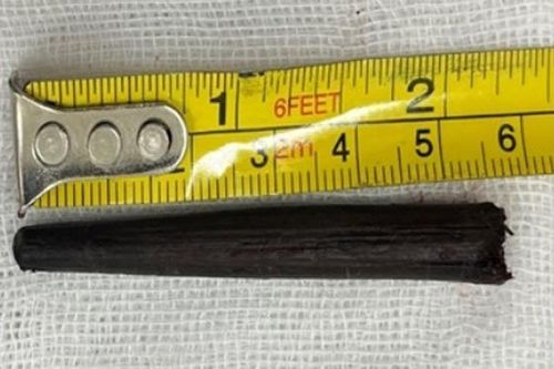 Hi hữu: Bị đũa gỗ dài gần 6cm đâm sâu vào hốc mắt