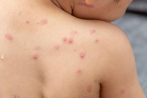 Điều nên làm và cấm kỵ khi mắc bệnh thủy đậu