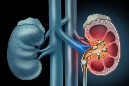 3 thói quen vô tình thành 'hung thủ' gây sỏi thận, nhiều người mắc phải