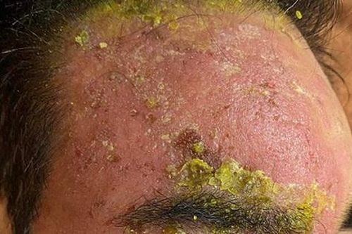 Suýt mù mắt do điều trị zona thần kinh sai cách, bác sĩ da liễu cảnh báo gì?