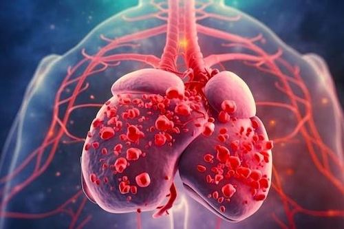 Nấc cụt suốt 3 tháng, người đàn ông bất ngờ nhận chẩn đoán ung thư