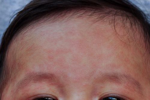 Việc cần làm khi gia đình có người bị bệnh sởi