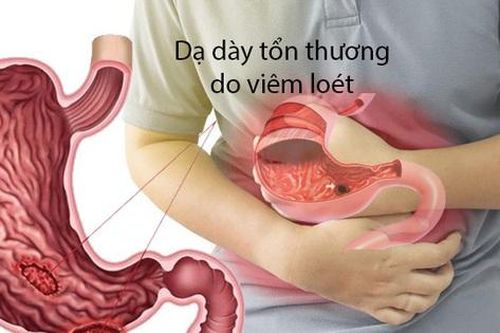 Lý do khiến bạn bị cơn đau dạ dày hành hạ