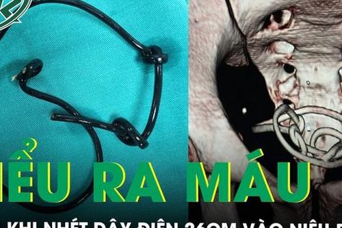 Nhét dây điện 26cm vào vùng kín theo 'thử thách khủng khiếp' trên mạng xã hội