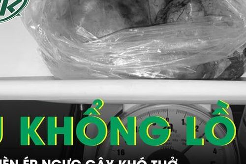 U khổng lồ chèn ép gây khó thở, đau ngực