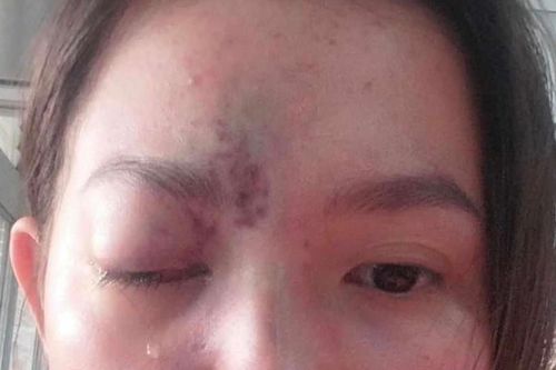 Mù một bên mắt sau khi tiêm filler làm đẹp