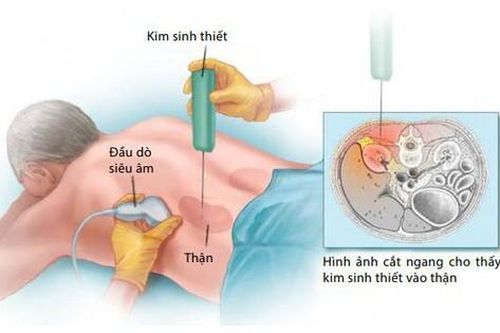 Khi nào phải sinh thiết thận?