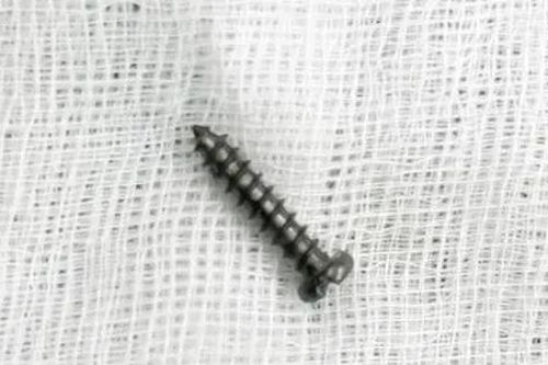 Gắp đinh vít dài 2cm trong ruột non bệnh nhi 28 tháng
