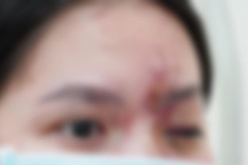 Cô gái 17 tuổi mù mắt vì tiêm filler ở tiệm cắt tóc, gội đầu