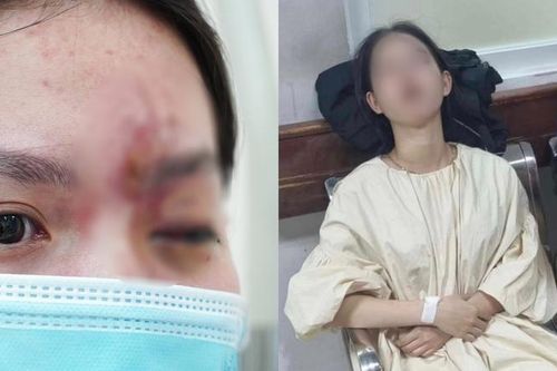 Tình trạng sức khỏe hiện tại của nữ sinh 17 tuổi bị mù mắt vì tiêm filler ở tiệm cắt tóc, gội đầu